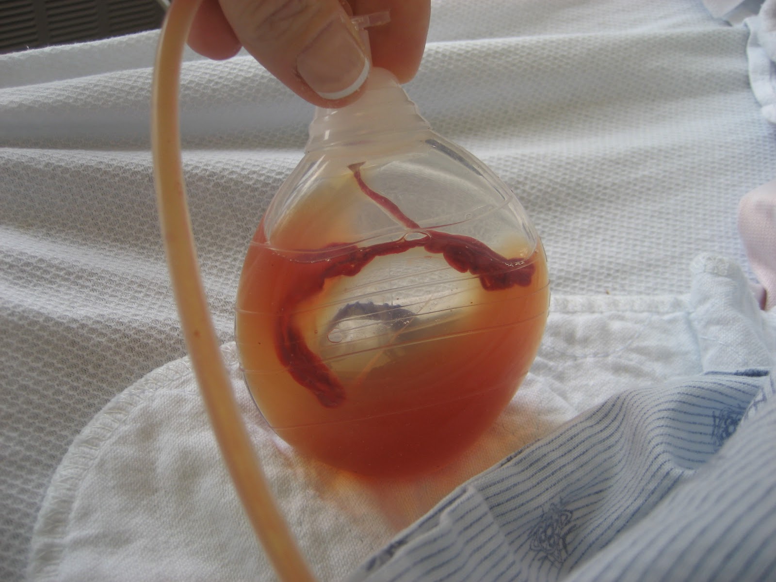 How To Remove A Drain Tube After Surgery at Peter Blessing blog