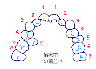歯科矯正のイラスト　©さんがつの歯科矯正を始めます