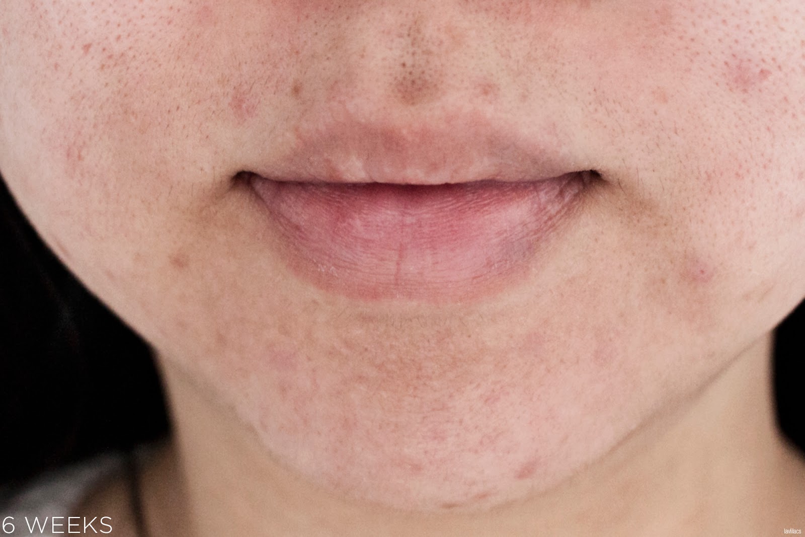tria Hair Removal Laser Facial Hair 6 Weeks Closeup