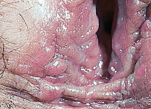 Papular warts of vaginal introitus and perineum