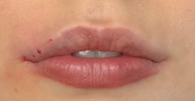 Vanessa S Beauty Blog Ich Habe Mir Die Lippen Aufspritzen Lassen