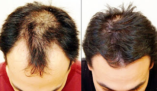 Testimoni Kirkland Minoxidil Penumbuh Rambut Kepala Testimoni Kirkland Minoxidil Penumbuh Rambut Kepala