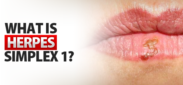 Ciri Ciri,Gejala,Penyebab Penyakit Herpes & Obat Herbalnya Ciri Ciri,Gejala,Penyebab Penyakit Herpes & Obat Herbalnya