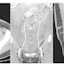 Do you need a CT angiogram before DIEP flap breast reconstruction? Do you need a CT angiogram before DIEP flap breast reconstruction?