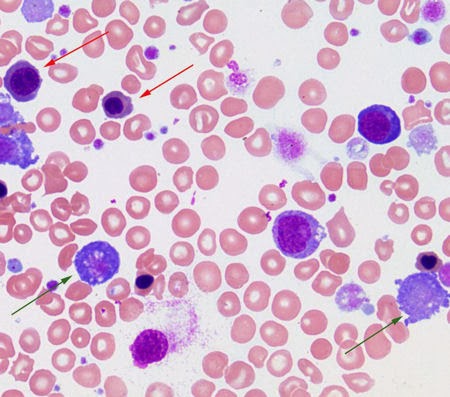 Medical Laboratory and Biomedical Science: Megakaryocytic fragments