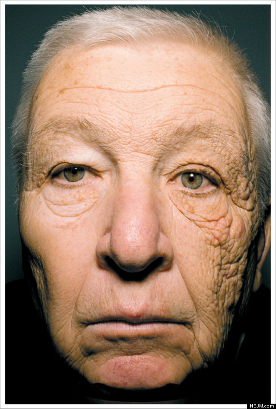 Truck Driver with wrinkles on one side of face
