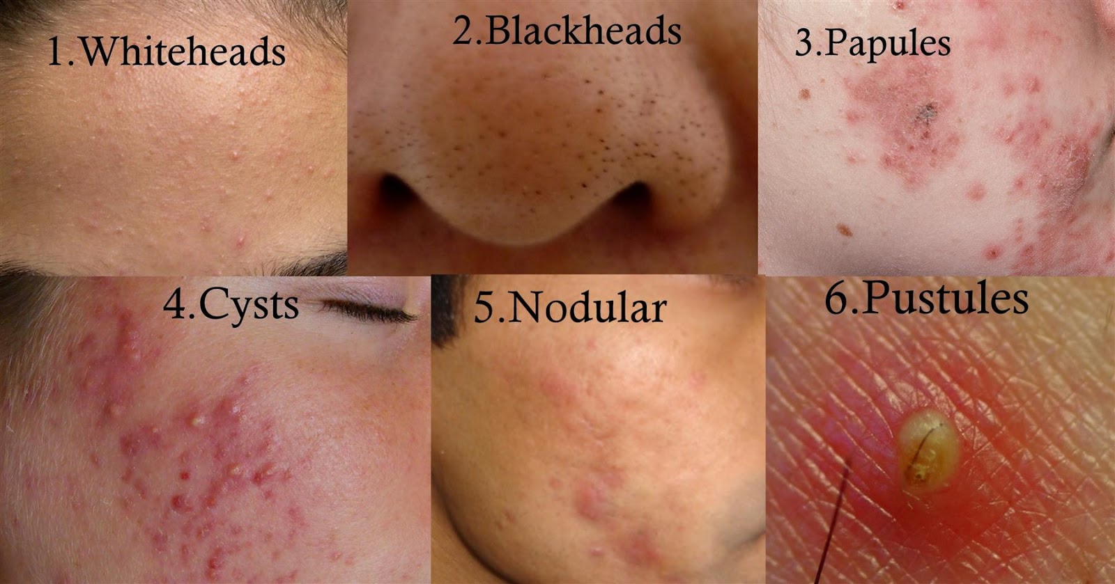 how-to-get-rid-of-acne-pimples-acne-cause-types-symptoms-tips