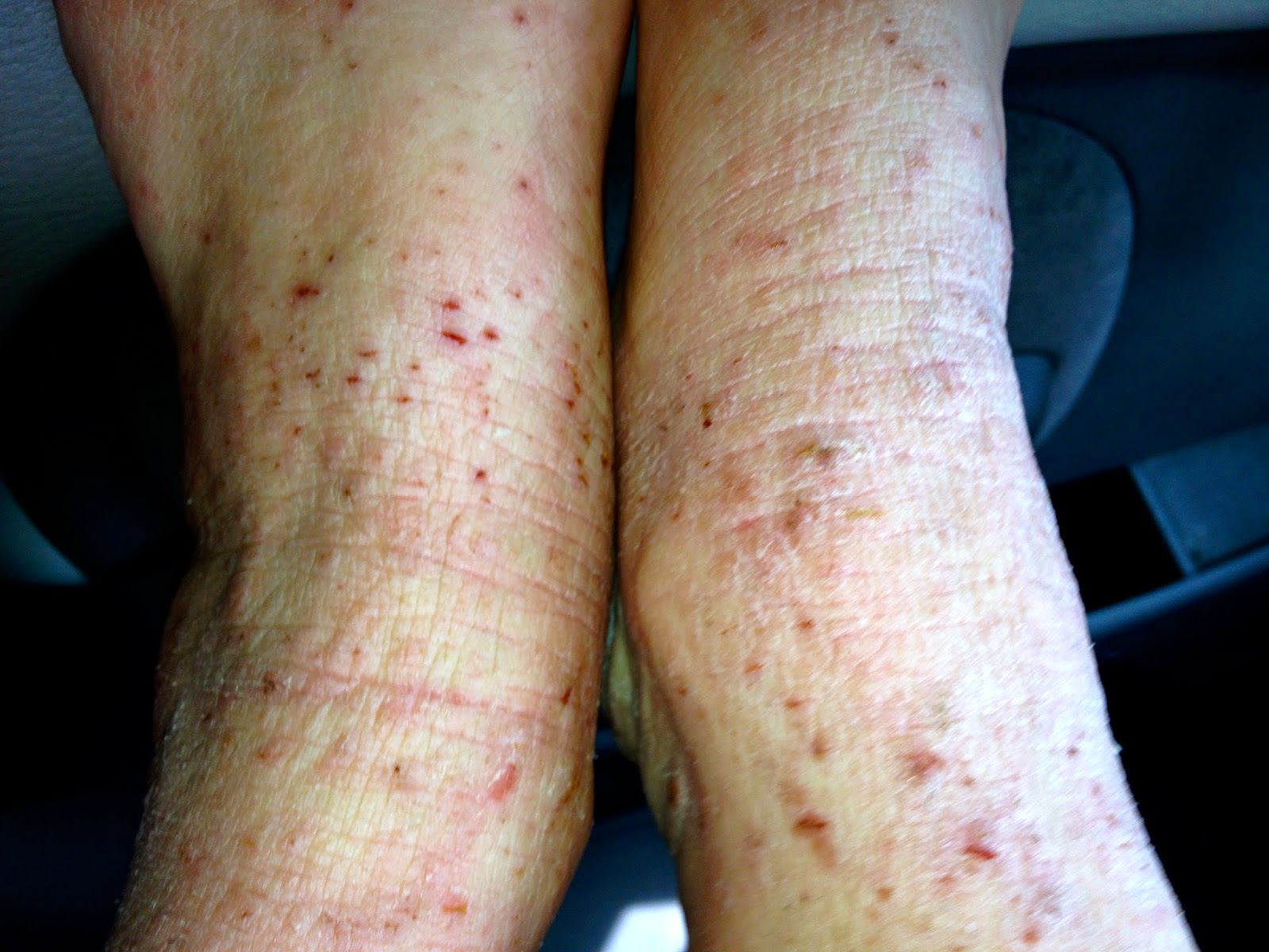 Scratching The Surface Of Topical Steroid Withdrawal 8 Months Of