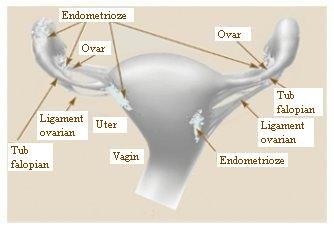 endometrioza și incapacitatea de a pierde în greutate)