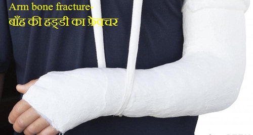 Arm bone fracture