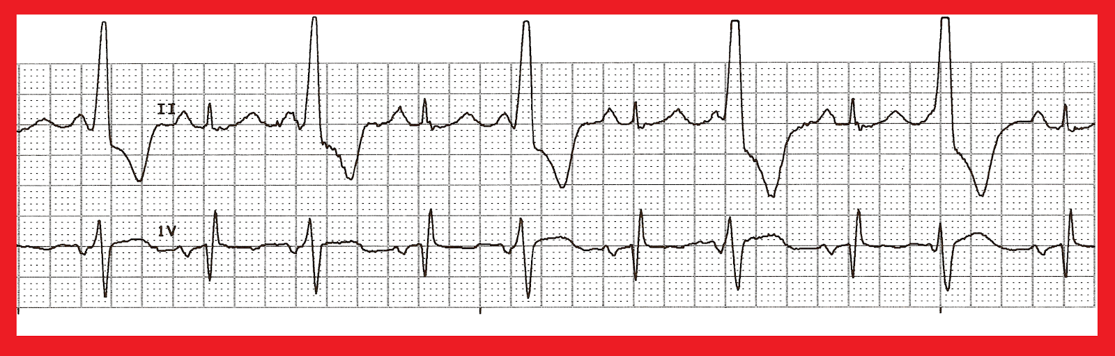 Various Bigeminal PVCs
