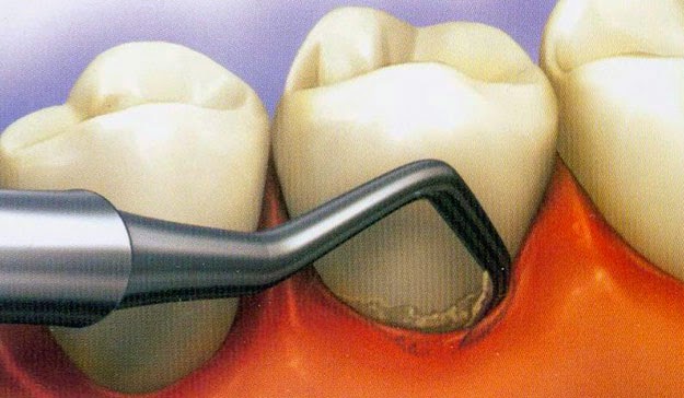 Détartrage dentaire et surfaçage radiculaire
