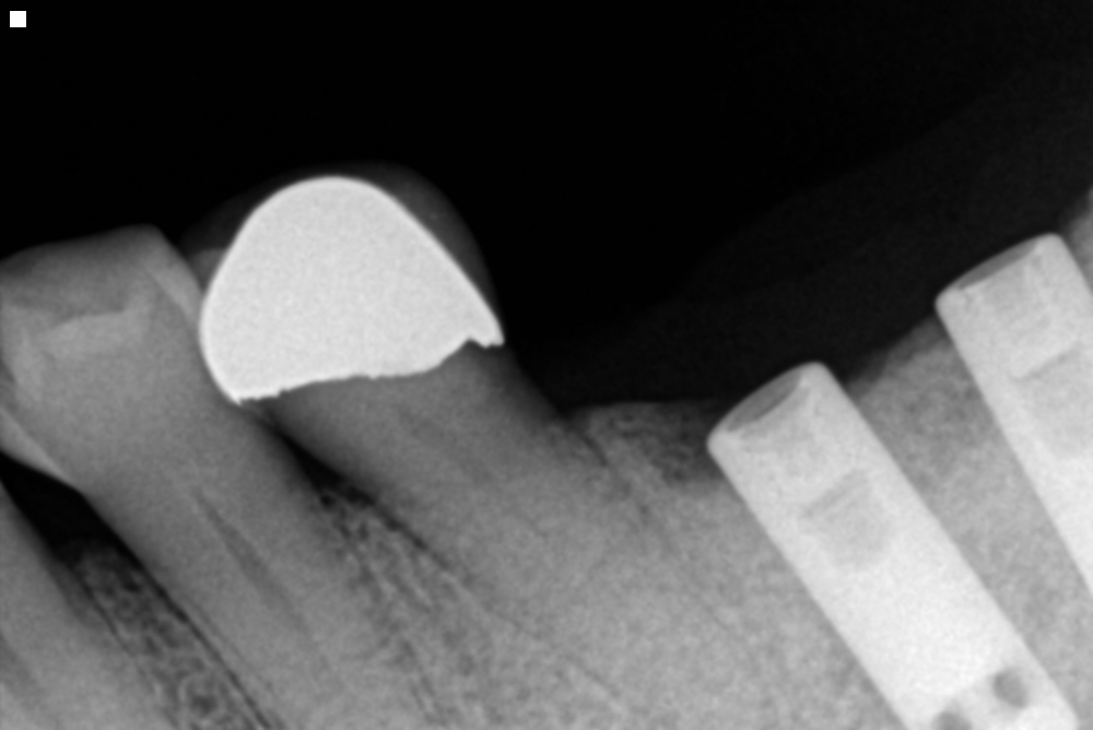 Rigby Advanced Dental Broken Implant Screws........No Problem!!