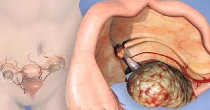 Stage 3 Ovarian Cancer Survival Rate - CancerOz