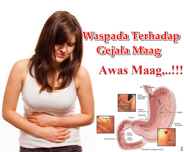 Cara Mengobati Sakit Maag Secara Alami Dan Tanpa Kambuh Lagi Cara Mengobati Sakit Maag Secara Alami Dan Tanpa Kambuh Lagi