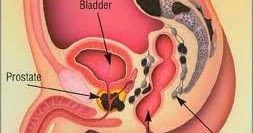 Treating Prostatitis Natural Remedies Treating Prostatitis Natural Remedies
