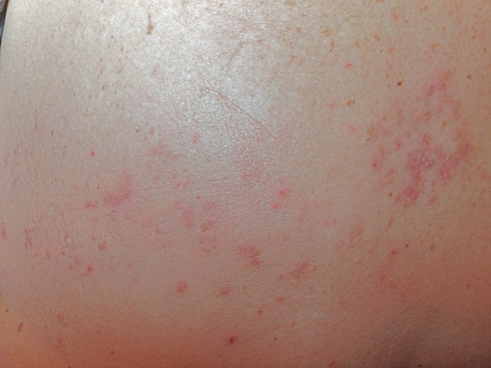 Ringworm Pictures: Rash, Skin Infections, Itching, Home ...