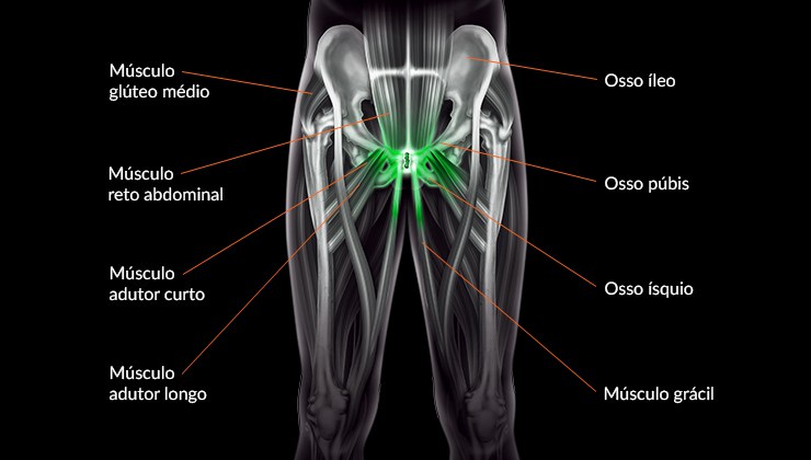 Pubalgia