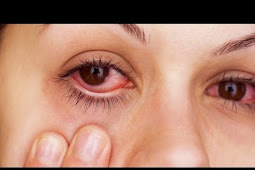 How To Treat Red Eyes From Allergies