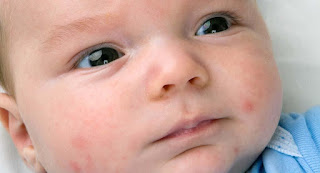 All You Need to Know about Baby Pimples All You Need to Know about Baby Pimples