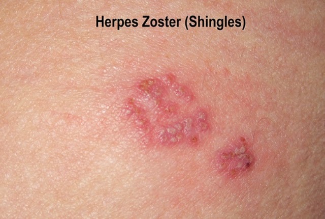 Genital Herpes in Adults: Condition, Treatments, and ...