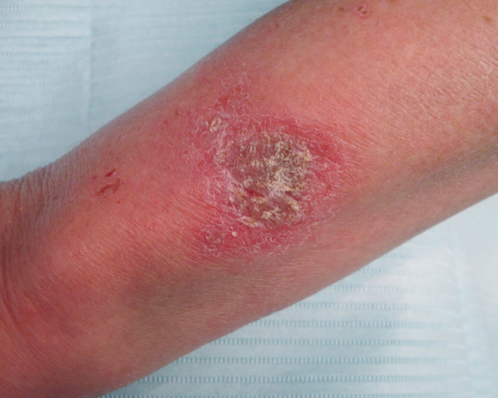 VIRTUAL GRAND ROUNDS IN DERMATOLOGY 2.0 FitBit Dermatitis