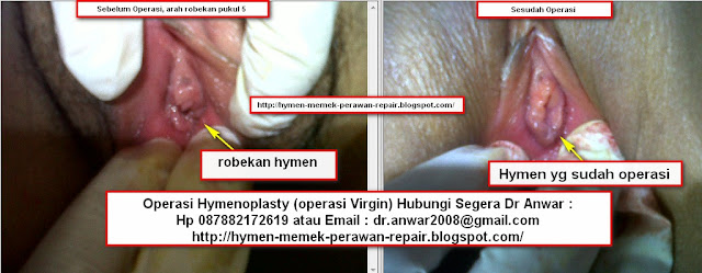 Operasi Hymen, Operasi Virgin, Operasi Perawan, Operasi Hymenoplasty