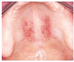 PDQ ORAL DISEASE: Petechiae