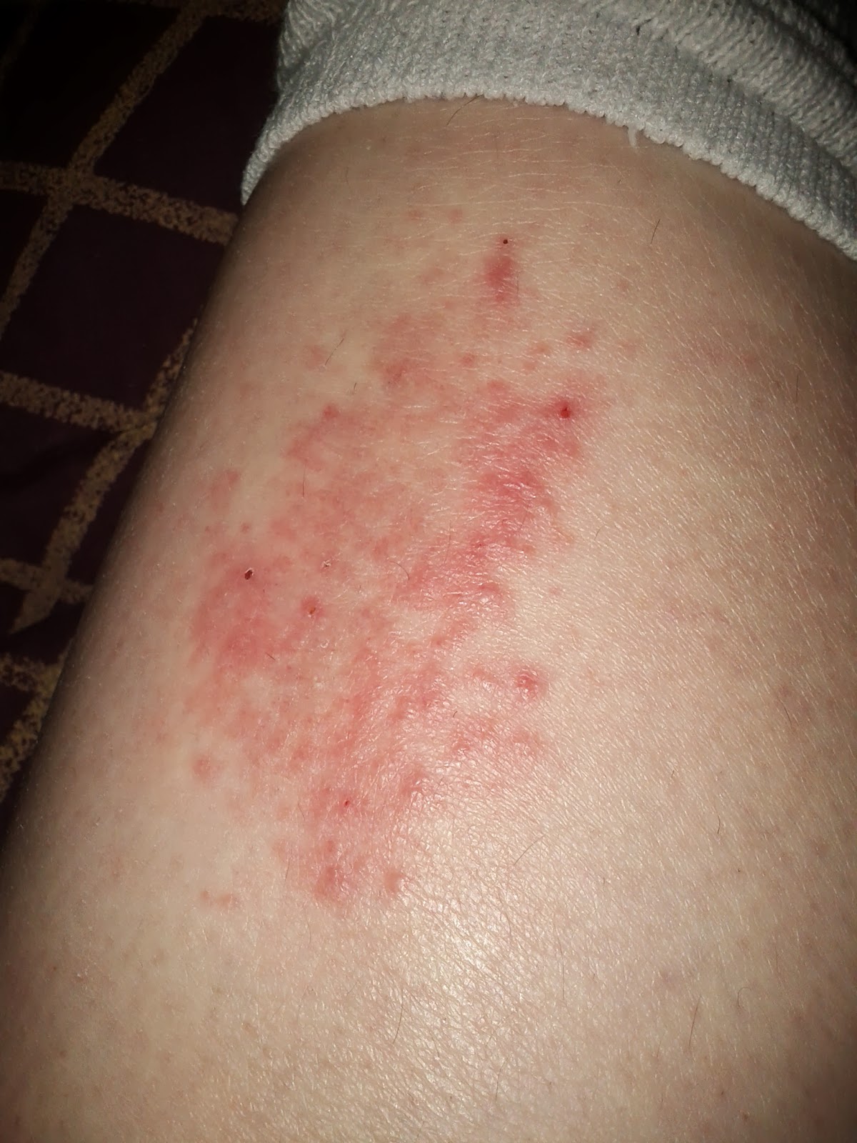 upper leg rash