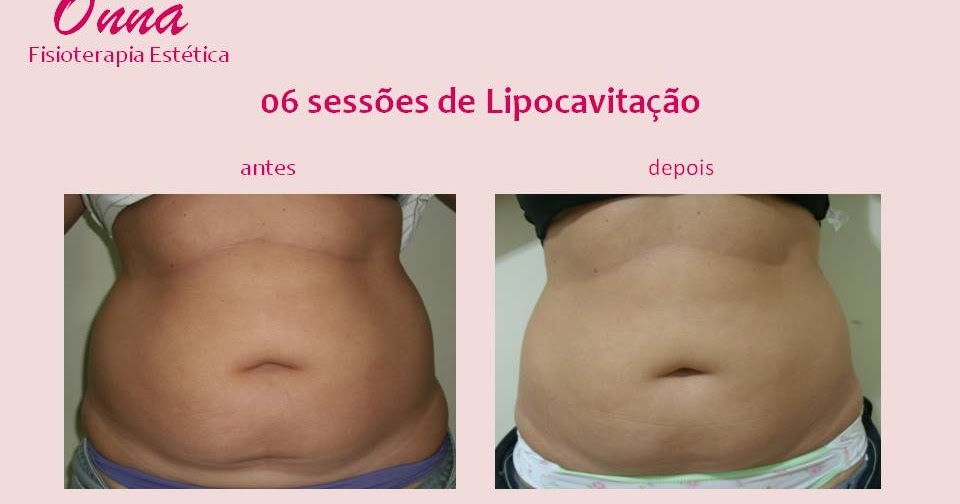 .: Lipocavitação - RESULTADO!