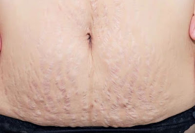 Stretch marks