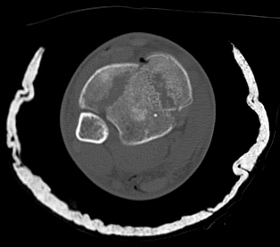 Open Pilon Case of the Month: Fracture cases at Harborview Medical Center ...