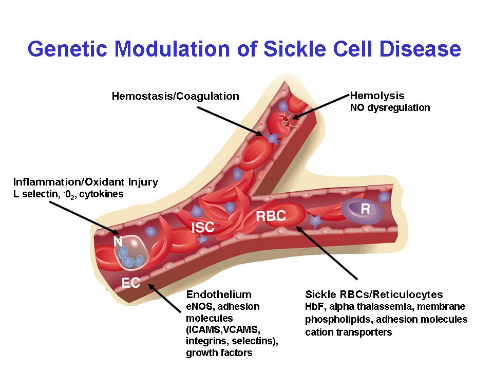 sickle cell diagram sickle cell anaemia dentistry and medicine sickle cell diagram sickle cell anaemia dentistry and medicine