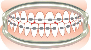 Comment apaiser les dents douloureuses des accolades