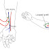 Arteriovenous (AV) Fistula/Shunt/Graft:36147 vs 36148,75791
