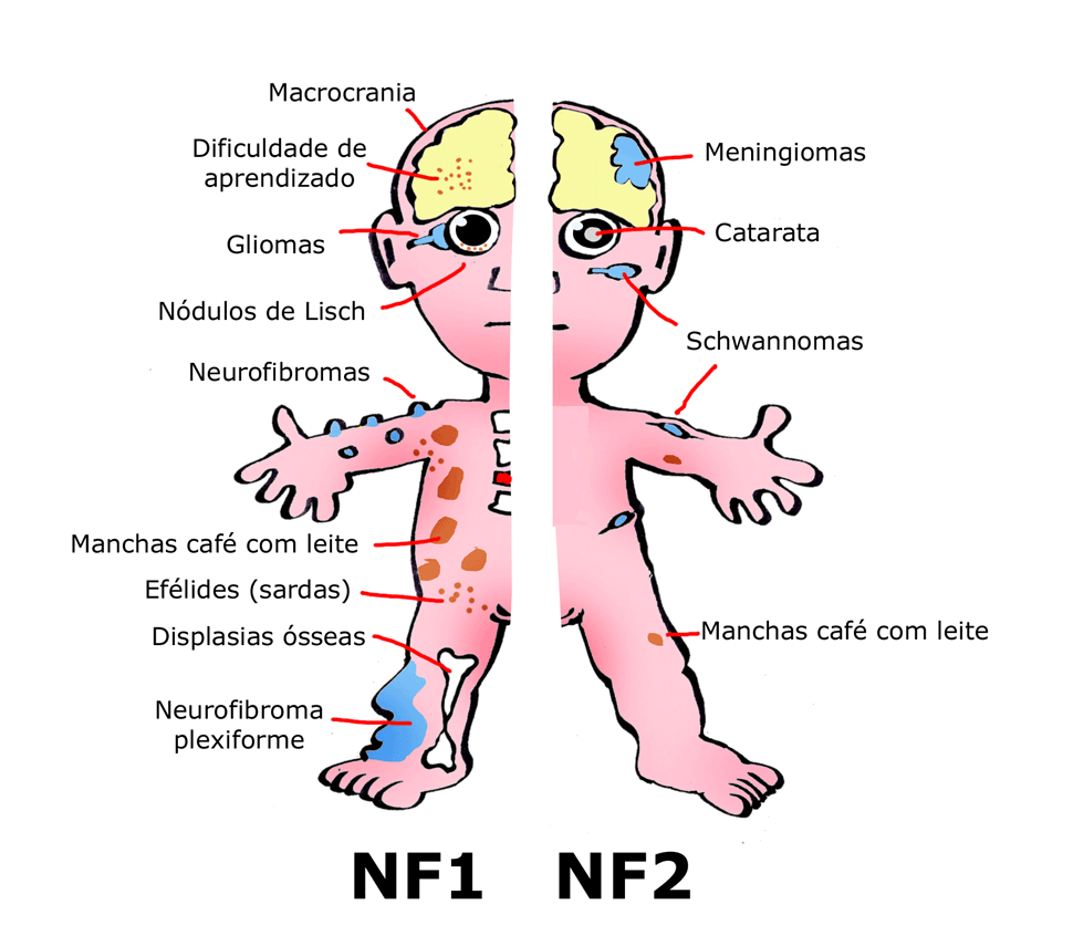 NEUROFIBROMATOSES - Dr LOR Semanalmente: Quais as diferenças entre NF1
