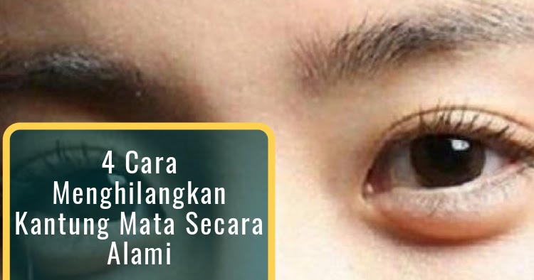 Cara menghilangkan kantung mata secara alami cepat dan permanen