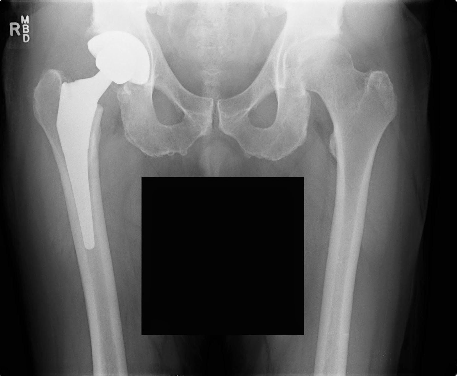 Medical Treatment Picturesfor Better Understanding Hip Surgery