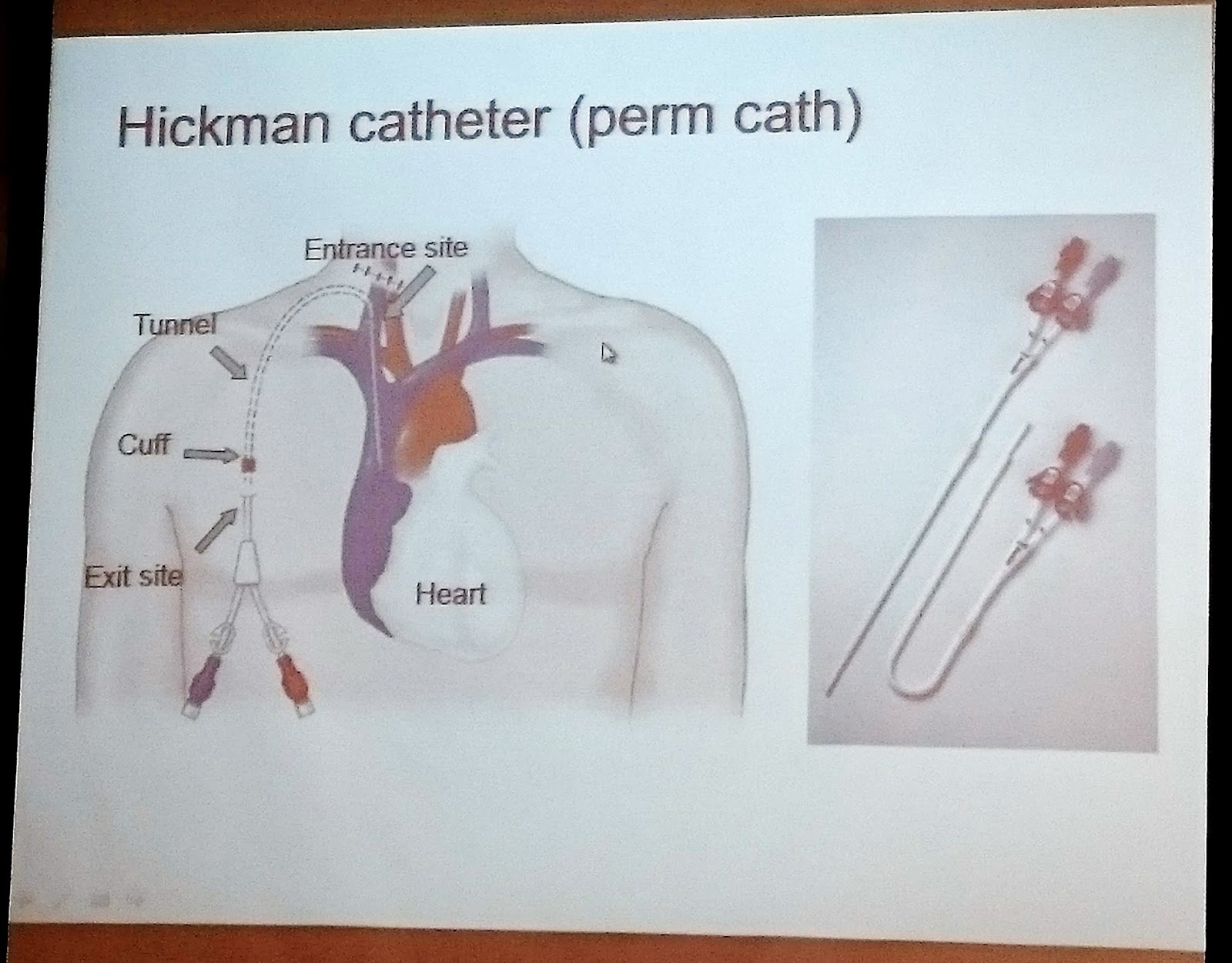 醫言兩語治療改革者 [醫如往常] Junior Clerkship Day 25 醫學不確定性; PD; 腹膜透析; HD; 血液透析