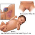Obat Hernia pada Bayi dan Wanita Tradisional dan Ampuh Obat Hernia pada Bayi dan Wanita Tradisional dan Ampuh