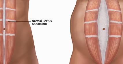Rectus abdominis muscle Sheath