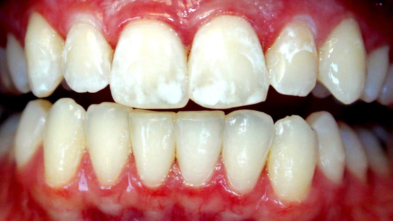 What Are The White Spots On Your Teeth - White Choices