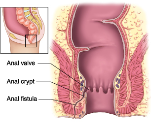 bulto adenomatoso en la próstata