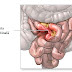 Ocluzia intestinală