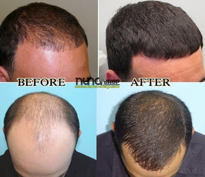 Cara Menumbuhkan Rambut Botak Dengan Cepat Dan Alami Cara Menumbuhkan Rambut Botak Dengan Cepat Dan Alami