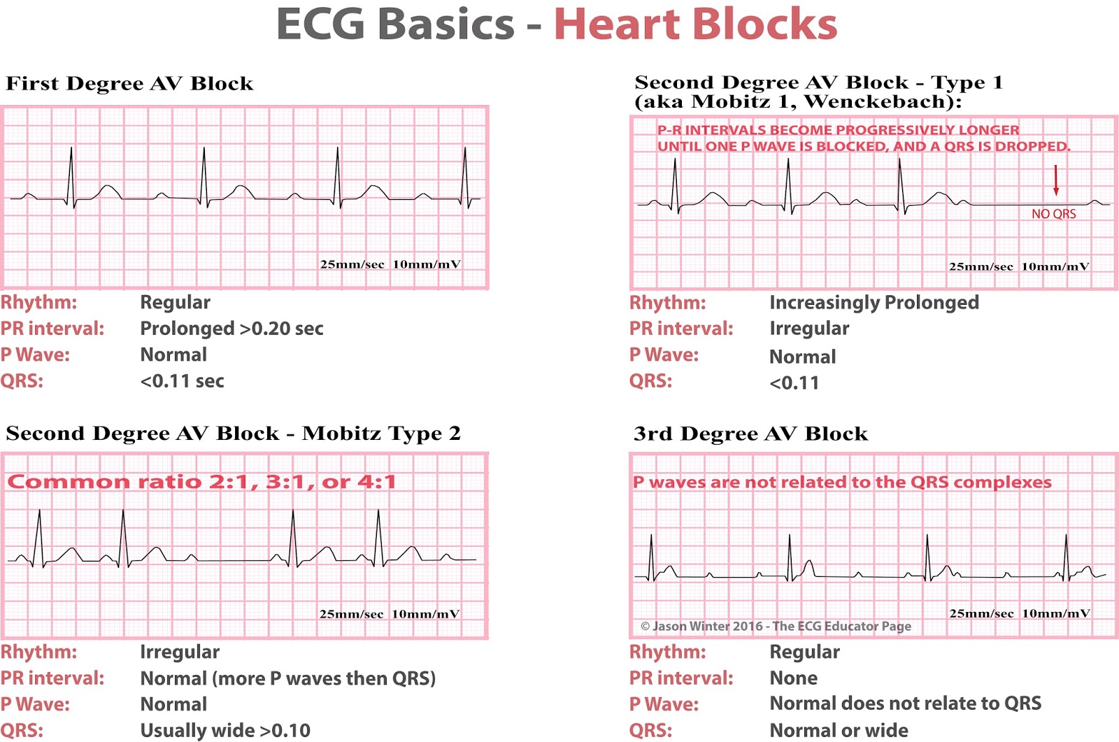 Heart Block On Ecg