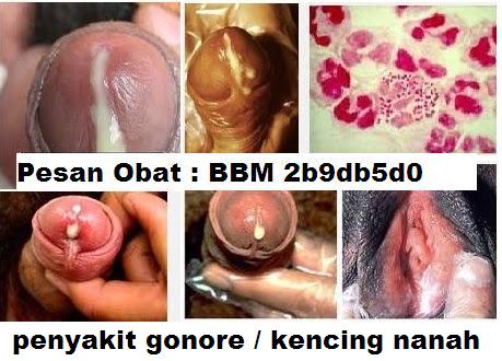 Ramuan Herbal Untuk Pengobatan Kencing Nanah Di Rumah Ramuan Herbal Untuk Pengobatan Kencing Nanah Di Rumah
