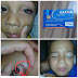 Depois de perder a visão de um olho, criança de 5 anos têm complicações e luta por uma cirurgia em Poço Verde/SE