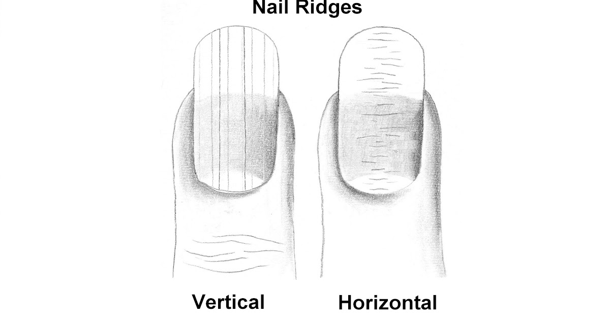 Long Ridges In Fingernails