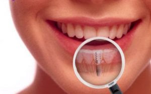 Cấy ghép implant gắn răng liền thế nào?